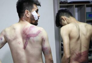 Journalists show their injuries after being beaten by the Taliban in Kabul, Afghanistan September 8, 2021. (Reuters)