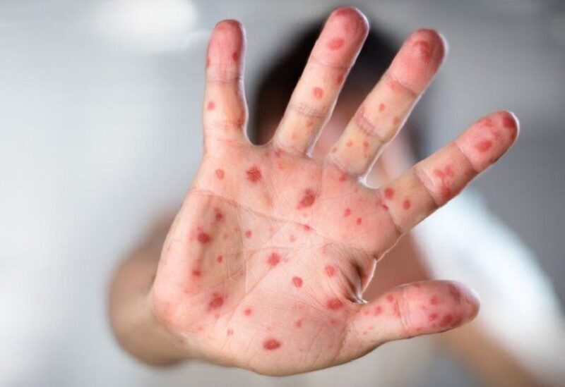 Is "monkeypox" spreading in Lebanon?