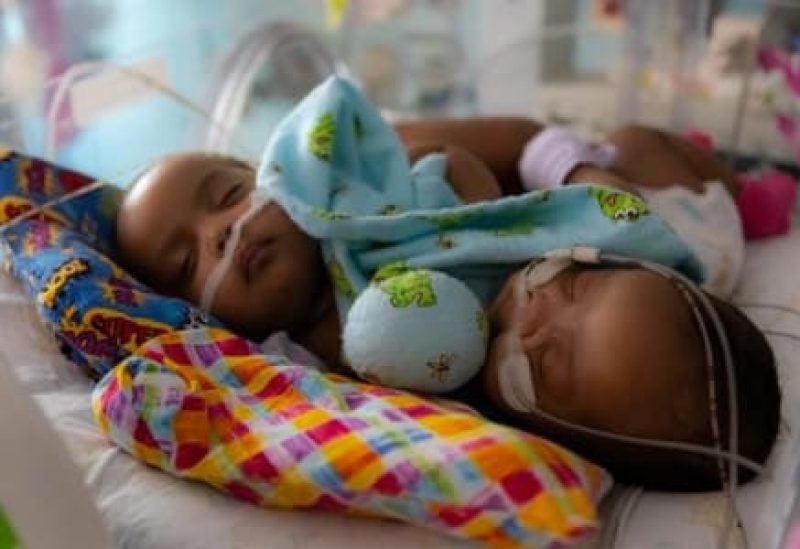 Conjoined Twins Separated In ‘historic’ 11 Hour Surgery At Texas Hospital Sawt Beirut